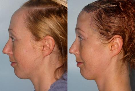 Hair Line Lowering before and after photos in San Francisco, CA, Patient 13963