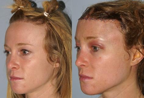 Hair Line Lowering before and after photos in San Francisco, CA, Patient 13972