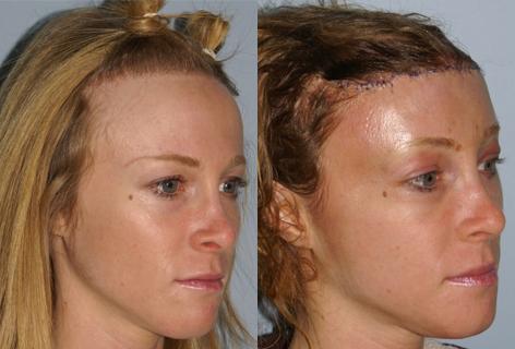 Hair Line Lowering before and after photos in San Francisco, CA, Patient 13972