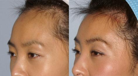 Hair Line Lowering before and after photos in San Francisco, CA, Patient 13981