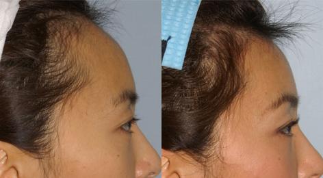 Hair Line Lowering before and after photos in San Francisco, CA, Patient 13981