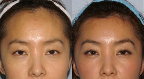 Hair Line Lowering before and after photos in San Francisco, CA, Patient 13981