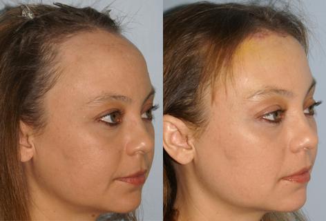 Hair Line Lowering before and after photos in San Francisco, CA, Patient 13988