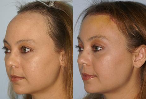 Hair Line Lowering before and after photos in San Francisco, CA, Patient 13988