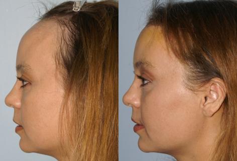 Hair Line Lowering before and after photos in San Francisco, CA, Patient 13988