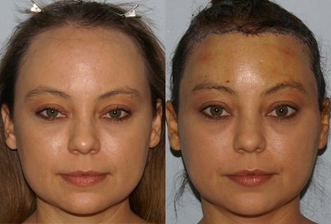 Hair Line Lowering before and after photos in San Francisco, CA, Patient 13988