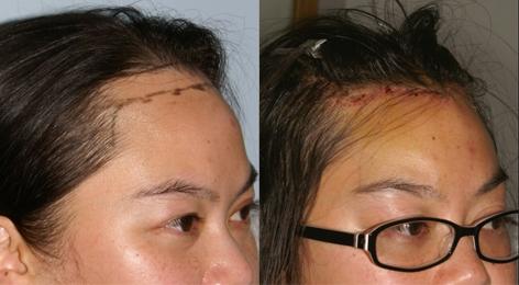 Hair Line Lowering before and after photos in San Francisco, CA, Patient 13999