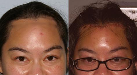 Hair Line Lowering before and after photos in San Francisco, CA, Patient 13999