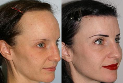 Hair Line Lowering before and after photos in San Francisco, CA, Patient 14004