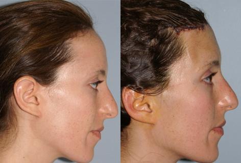 Hair Line Lowering before and after photos in San Francisco, CA, Patient 14011