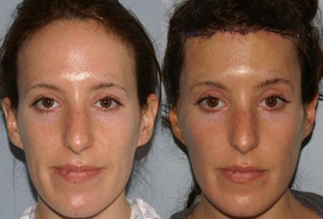 Patient 14011, Hair Line Lowering before and after photos Hair Line Lowering before and after photos in San Francisco, CA, Patient 14011