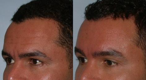 Hair Line Lowering before and after photos in San Francisco, CA, Patient 14027