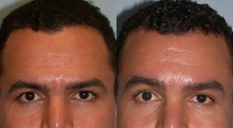 Hair Line Lowering before and after photos in San Francisco, CA, Patient 14027