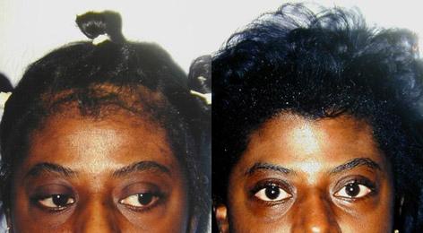 Hair Line Lowering before and after photos in San Francisco, CA, Patient 14032