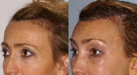 Patient 14047, Hair Line Lowering before and after photos Hair Line Lowering before and after photos in San Francisco, CA, Patient 14047