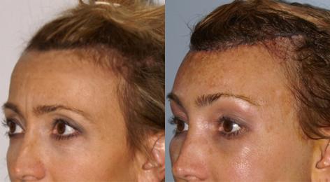 Hair Line Lowering before and after photos in San Francisco, CA, Patient 14047