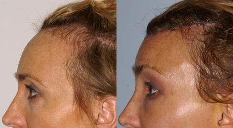 Hair Line Lowering before and after photos in San Francisco, CA, Patient 14047