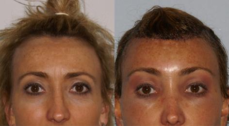 Hair Line Lowering before and after photos in San Francisco, CA, Patient 14047