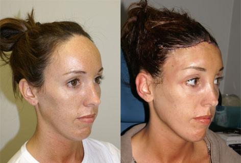 Hair Line Lowering before and after photos in San Francisco, CA, Patient 14059