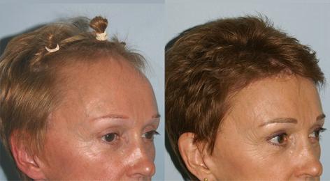 Hair Line Lowering before and after photos in San Francisco, CA, Patient 14072