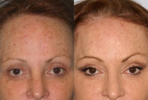 Hair Line Lowering before and after photos in San Francisco, CA, Patient 14077
