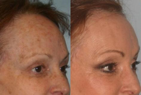 Hair Line Lowering before and after photos in San Francisco, CA, Patient 14077