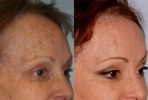 Hair Line Lowering before and after photos in San Francisco, CA, Patient 14077