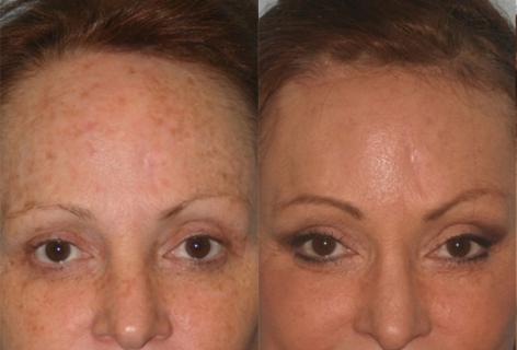 Hair Line Lowering before and after photos in San Francisco, CA, Patient 14077