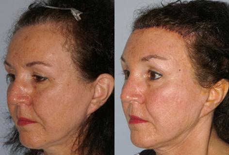 Hair Line Lowering before and after photos in San Francisco, CA, Patient 14089