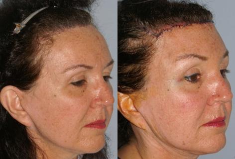 Hair Line Lowering before and after photos in San Francisco, CA, Patient 14089