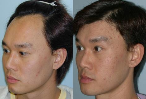 Hair Line Lowering before and after photos in San Francisco, CA, Hairline Lowering in San Francisco, CA