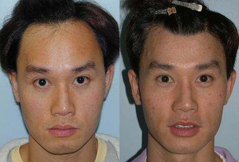 Hair Line Lowering before and after photos in San Francisco, CA, Hairline Lowering in San Francisco, CA