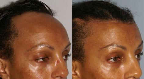 Hair Line Lowering before and after photos in San Francisco, CA, Patient 14101