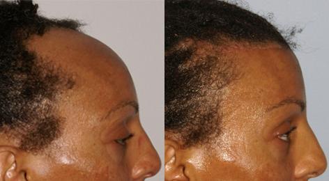 Hair Line Lowering before and after photos in San Francisco, CA, Patient 14101