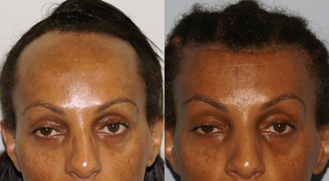 Hair Line Lowering before and after photos in San Francisco, CA, Patient 14101