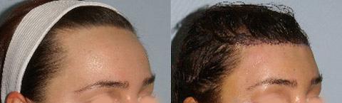 Hair Line Lowering before and after photos in San Francisco, CA, Patient 14108