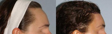 Hair Line Lowering before and after photos in San Francisco, CA, Patient 14108