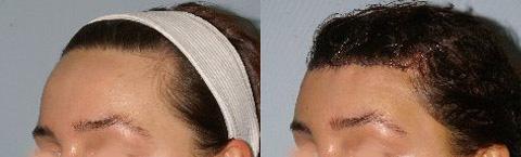 Hair Line Lowering before and after photos in San Francisco, CA, Patient 14108