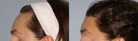 Hair Line Lowering before and after photos in San Francisco, CA, Patient 14108