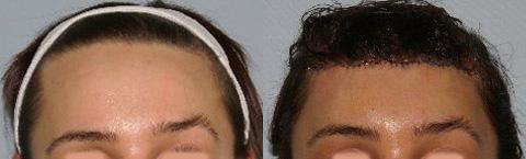 Hair Line Lowering before and after photos in San Francisco, CA, Patient 14108