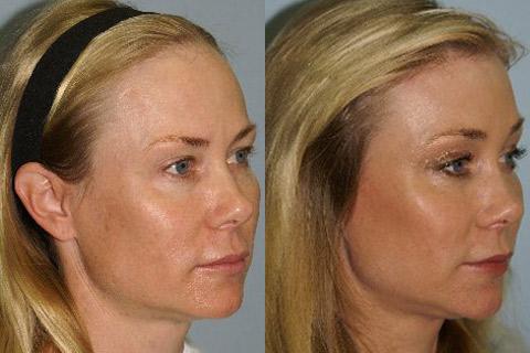 Hair Line Lowering before and after photos in San Francisco, CA, Patient 14119