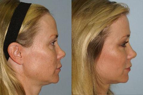 Hair Line Lowering before and after photos in San Francisco, CA, Patient 14119