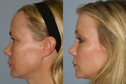 Hair Line Lowering before and after photos in San Francisco, CA, Patient 14119