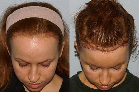 Hair Line Lowering before and after photos in San Francisco, CA, Patient 14128