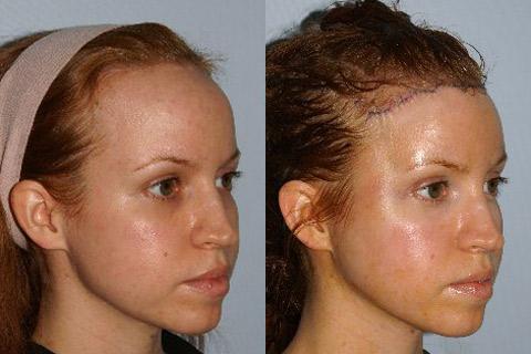 Hair Line Lowering before and after photos in San Francisco, CA, Patient 14128