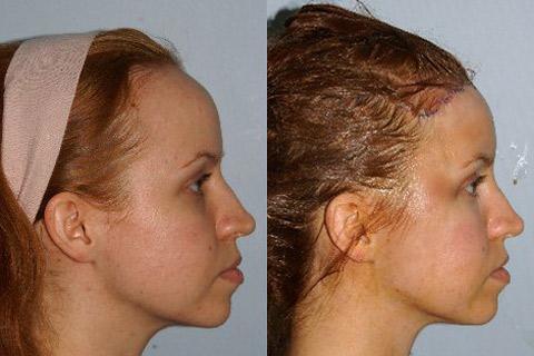 Hair Line Lowering before and after photos in San Francisco, CA, Patient 14128