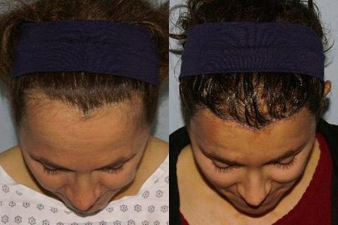 Hair Line Lowering before and after photos in San Francisco, CA, Patient 14139