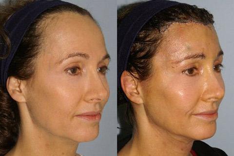 Hair Line Lowering before and after photos in San Francisco, CA, Patient 14139