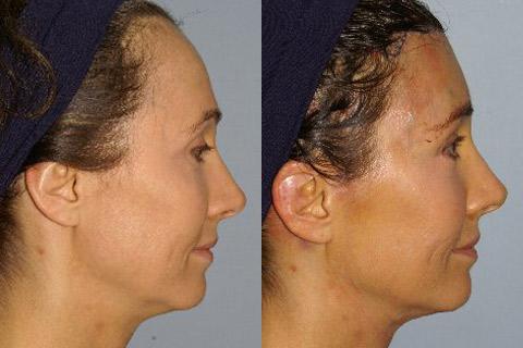 Hair Line Lowering before and after photos in San Francisco, CA, Patient 14139