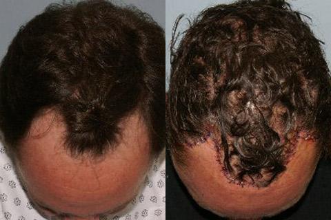 Hair Line Lowering before and after photos in San Francisco, CA, Patient 14150